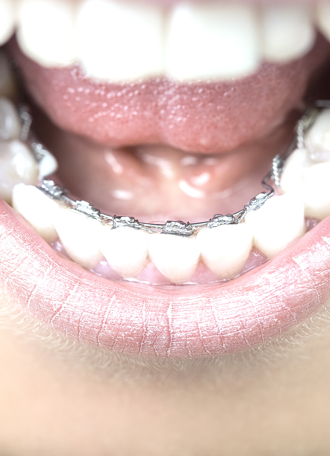 KiO4U - unsichtbare Zahnspangen